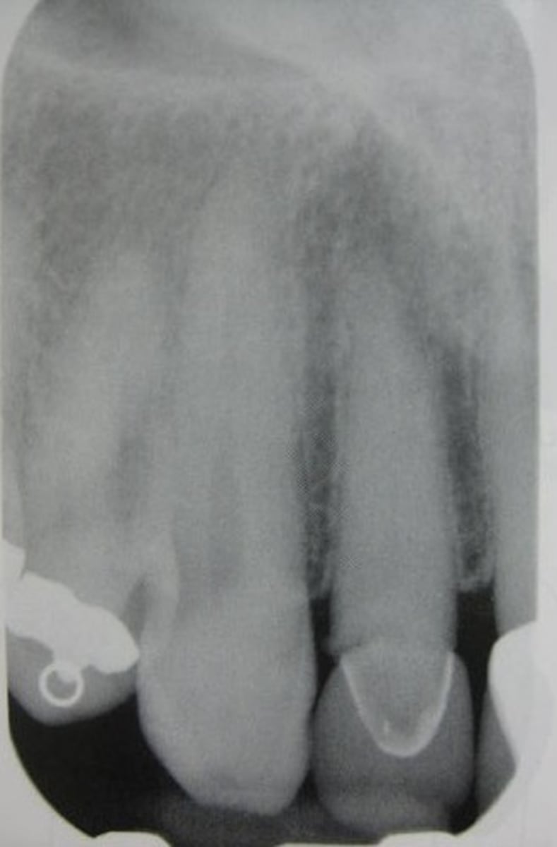 <p>Identify restoration type in the center</p>