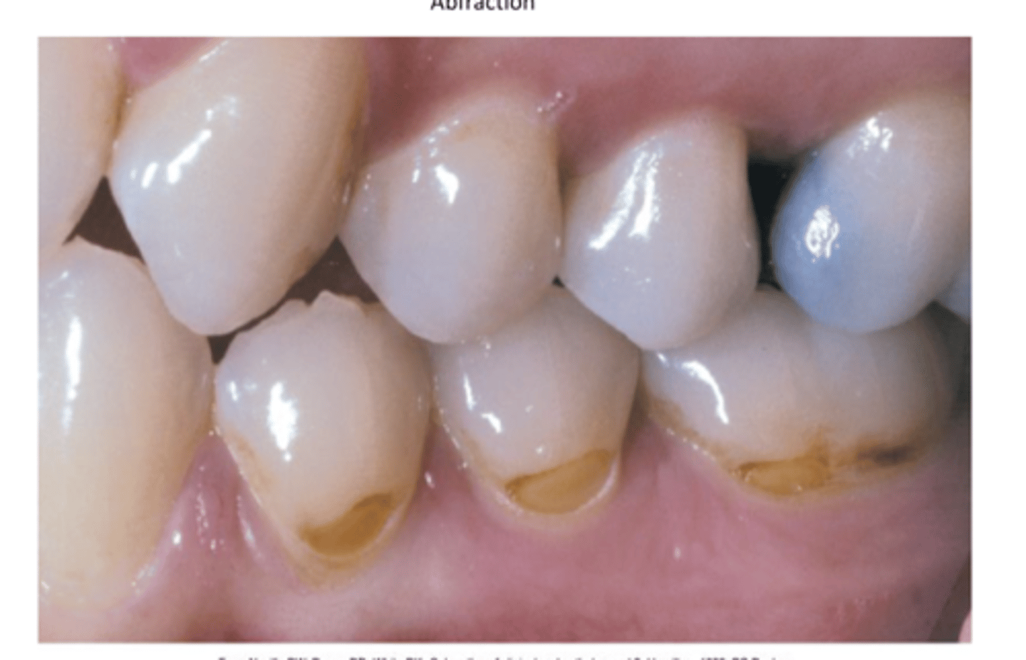 <p>affects cervical areas</p><p>--> V or wedge-shaped defect, deep and narrow</p><p>caused by microfracture to tooth structure in areas of high stress, can be related to fatigue, flexure, fraction, and deformation of tooth structure due to biomechanical forces</p>