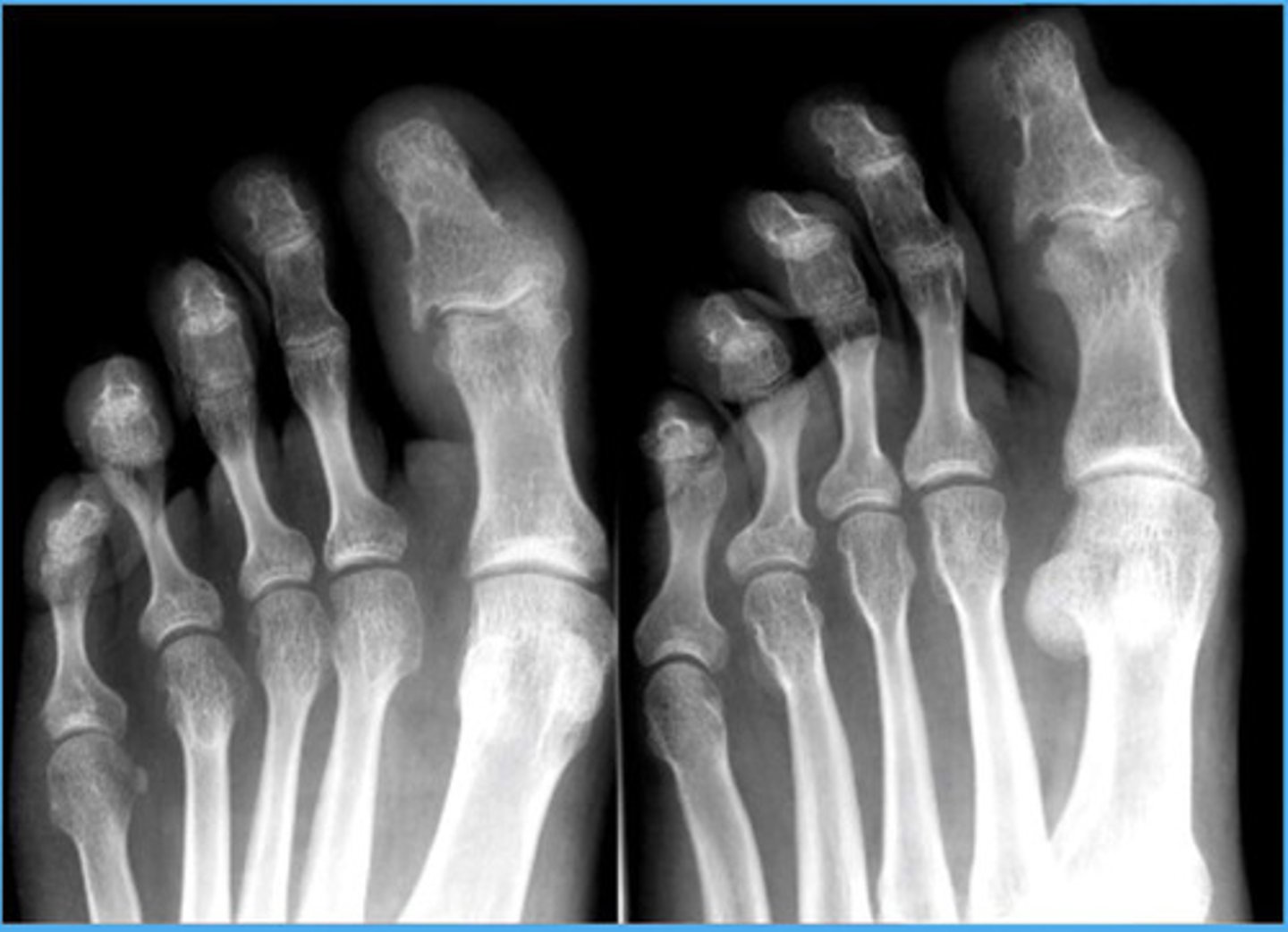 <p>Normal bone density, but shaggy periosteum</p>