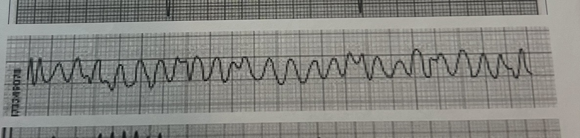 <p>Ventricular fibrillation </p>