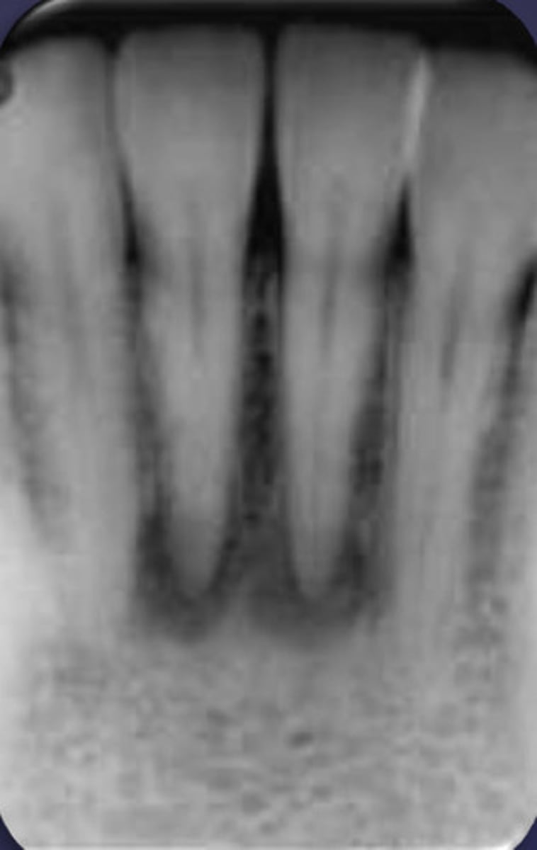 <p>how would you describe this lesion?</p><p>A. well-defined, periapical radiolucent lesion associated with #24 and 25</p><p>B. ill-defined, periapical radiolucent lesion associated with #24 and 25</p><p>C. well- defined, multilocular periapical lesion associated with tooth number 24 and 25</p><p>D. mixed density, periapical lesion associated with teeth number 24 and 25</p>