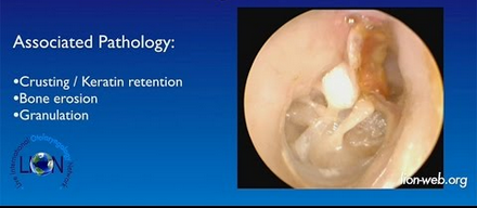 <p>hx chronic/reccurrent ear infections</p>