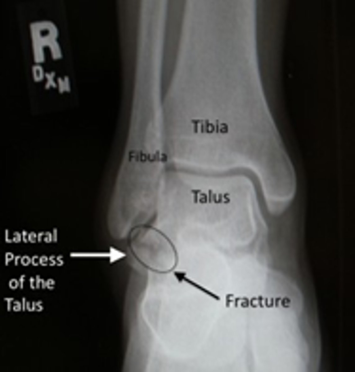<p>fracture of the lateral process of the talus</p>