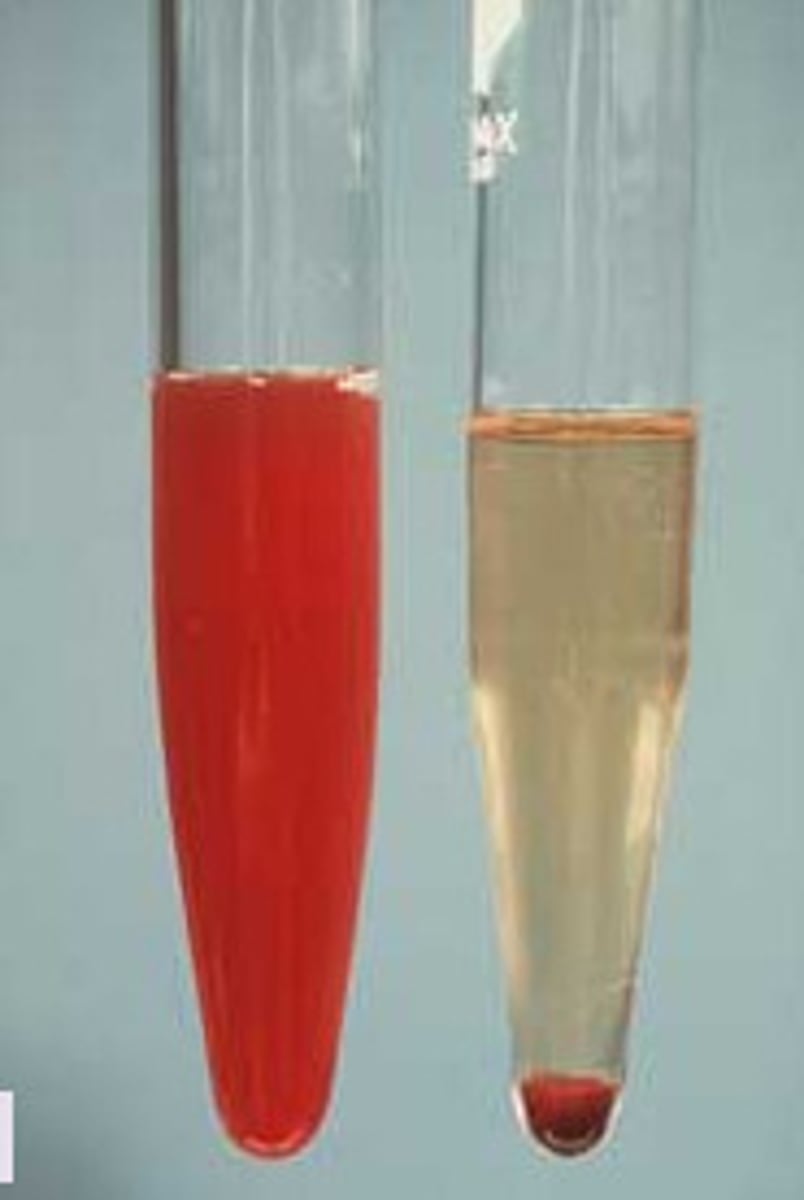 <p>blood in the urine</p>