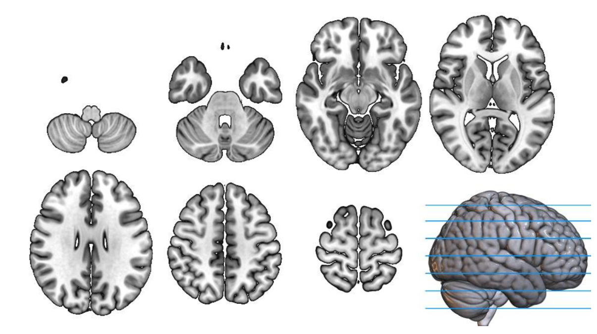 <p>split brain into front and back, shows the brain as if looking at the person straight on</p>