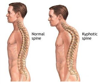 <p>Foward rounding of spine (Humpback)</p>