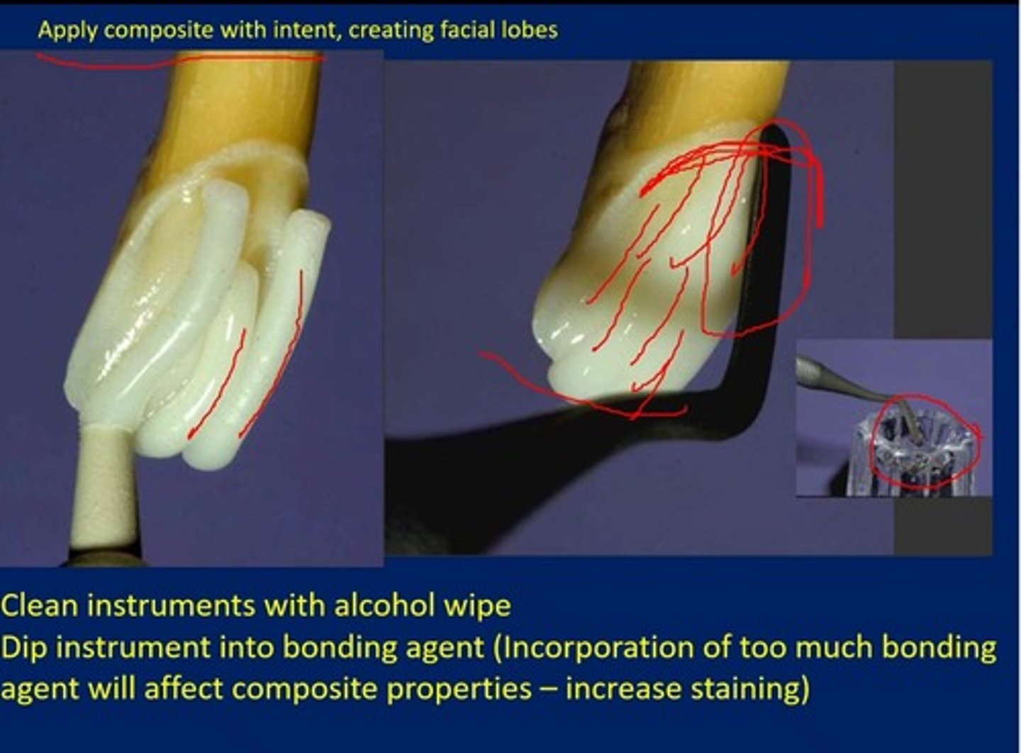 <p>at the gingival margin to ensure it is closed and then pushing it incisally. It is much easier to remove excess material from the incisal.</p>