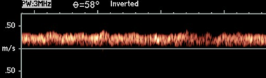 <p>continous hepatopetal flow with slight respiratory variation </p><ul><li><p>flow is pulsatile/biphasic with cardiac issues </p></li></ul><p></p>