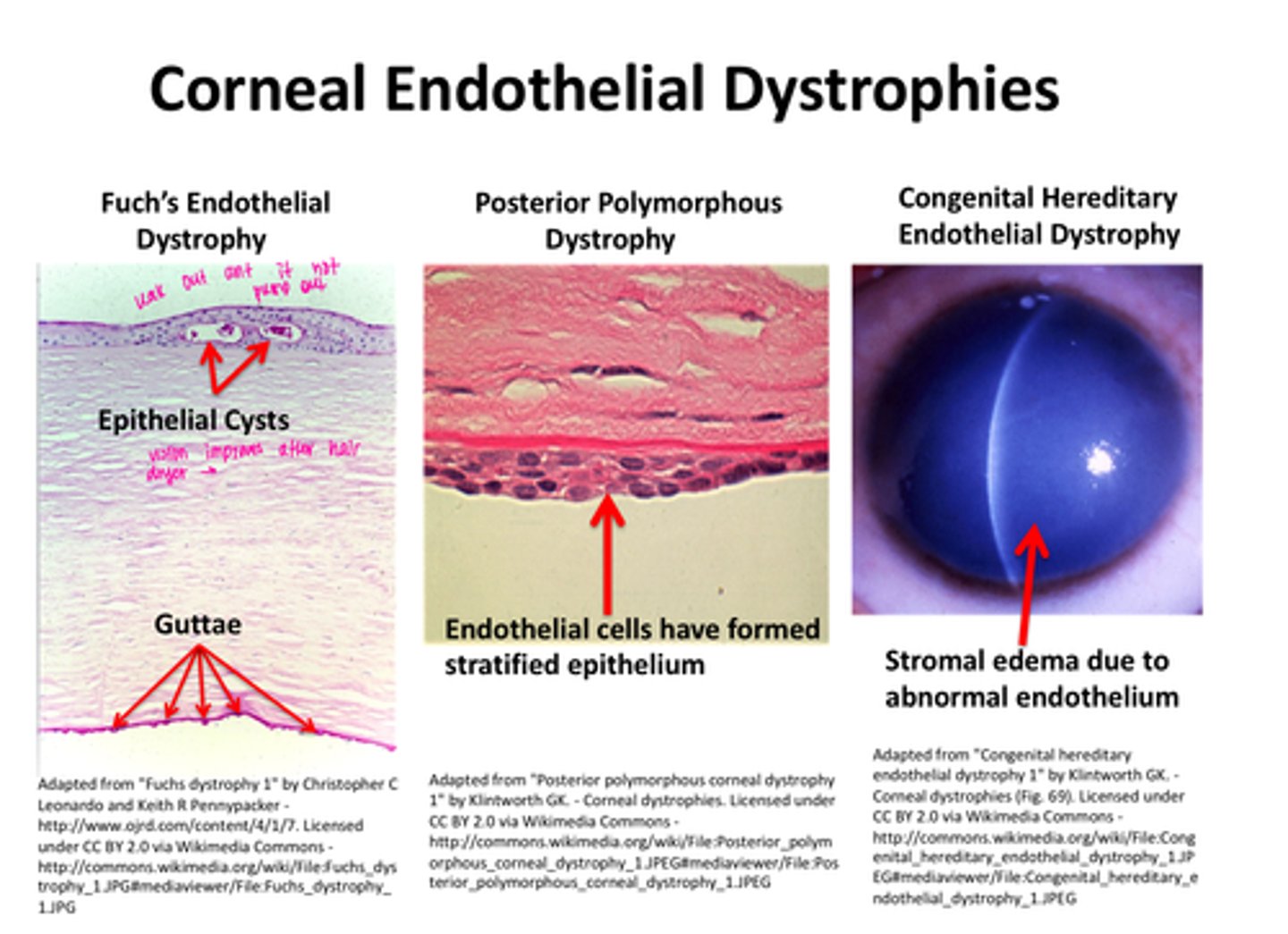 <p>-Fuch's Endothelial dystrophy - epithelial cysts and guttae</p><p>-Posterior Polymorphous Dystrophy - endothelial cells have formed stratified epithelium</p><p>-Congenital Hereditary Endothelial Dystrophy - stromal edema due to abnormal endothelium</p>