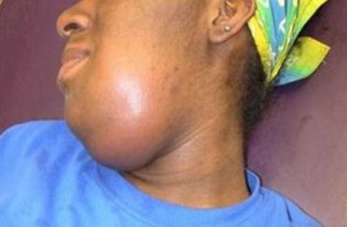 <p>is cellulitis of the submandibular space, with a risk of spreading to the parapharyngeal space and then onto the retropharyngeal space of the neck</p>