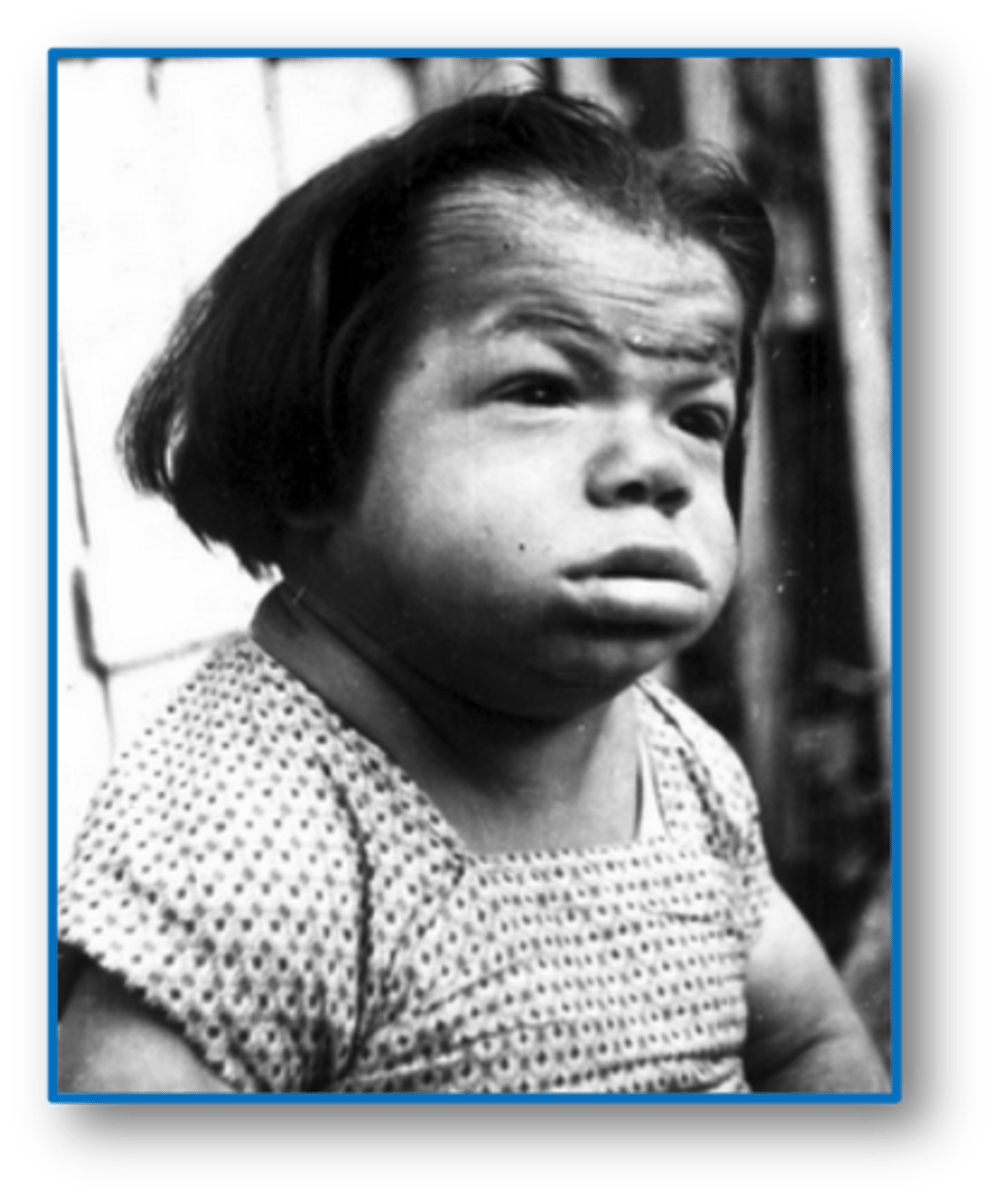 <p>infancy and childhood hypothyroidism</p><p>-thickened lips</p><p>-enlarged tongue</p><p>-delayed eruption of teeth</p>