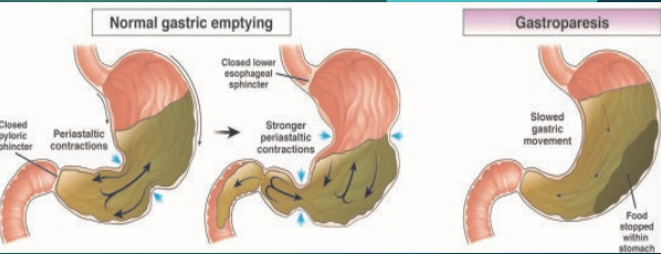 <p><strong>Gastroparesis: Background</strong></p><p>-Delayed gastric ___________ in the ________ of mechanical gastric outlet obstruction </p><p>-Pathophysiology → abnormalities of the _________ nervous system, smooth muscle cells, _______ neurons and GI hormones </p>
