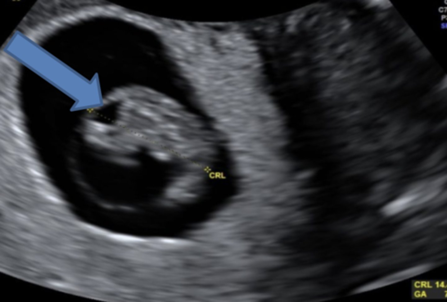 <p>cystic rhomboid fossa</p>