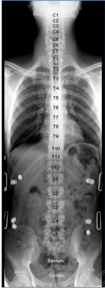 <p>The vertebral column is divided into five regions:</p><ul><li><p><strong>Cervical (7 vertebrae, C1-C7)</strong>: located in the neck, responsible for supporting the head and allowing neck movement. <mark data-color="yellow" style="background-color: yellow; color: inherit">Greatest range of movement</mark></p></li><li><p><strong>Thoracic (12 vertebrae, T1-T12)</strong>: provide attachment for ribs, providing stability and protecting the thoracic organs<mark data-color="yellow" style="background-color: yellow; color: inherit">. Greatest degree of rotation-due to location of articular facets</mark></p></li><li><p><strong>Lumbar (5 vertebrae, L1-L5)</strong>: supports much of the upper body's weight and is located in the lower back.</p></li><li><p><strong>Sacrum (5 fused vertebrae)</strong>: <mark data-color="yellow" style="background-color: yellow; color: inherit">forms the posterior part of the pelvic girdle.</mark></p></li><li><p><strong>Coccyx (4 fused vertebrae)</strong>: commonly referred to as the tailbone,<mark data-color="yellow" style="background-color: yellow; color: inherit"> it provides attachment for ligaments and muscles of the pelvic floor​. Stabilise the sitting person</mark></p></li></ul><p></p>