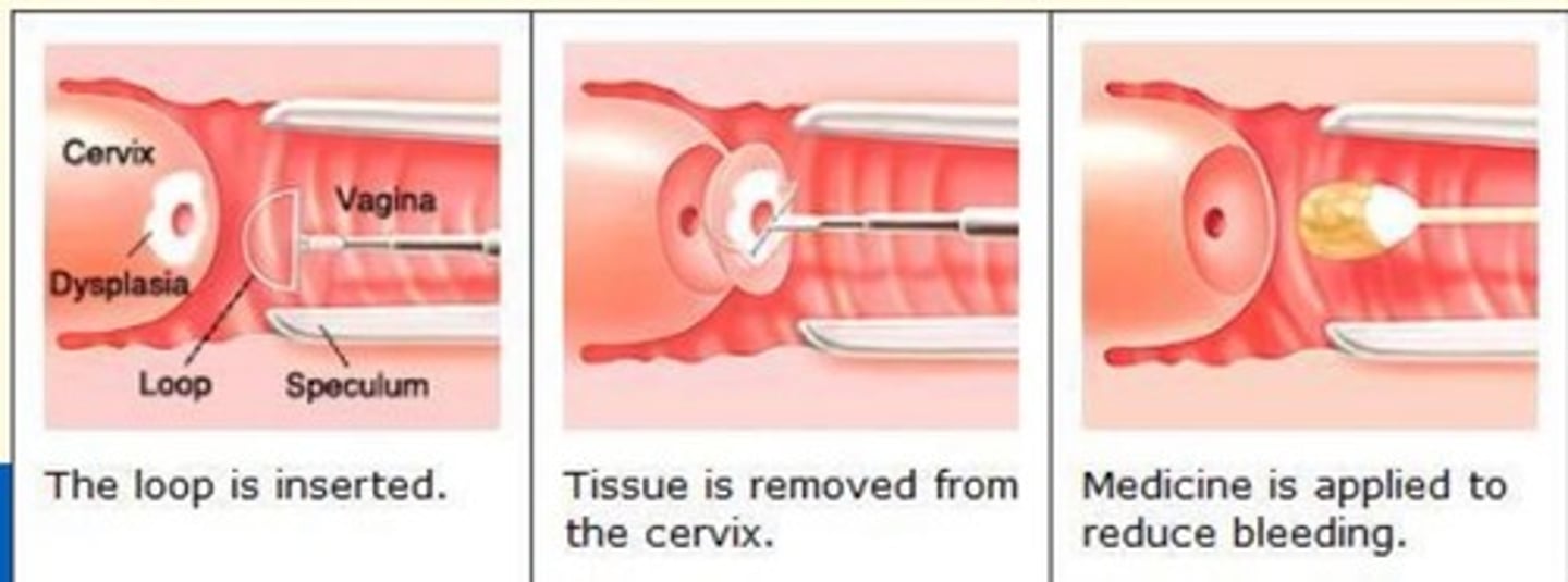 <p>Gynecologic procedure that uses a thin, low-voltage electrified wire loop to cut out/remove abnormal tissue in the cervix or vagina</p>