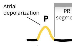 <p>Atrial depolarization</p>