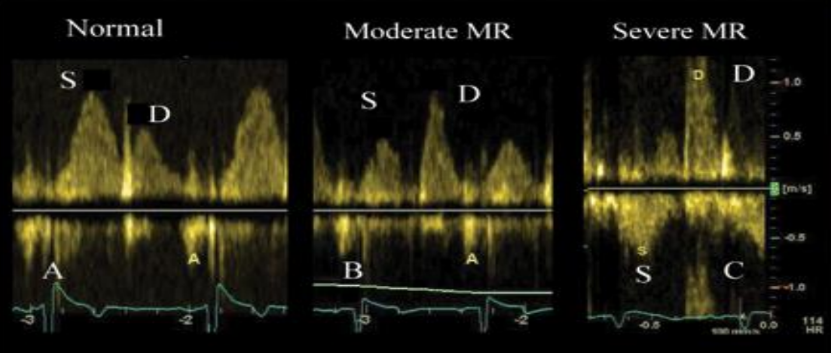 <p>To check if the regurge is going down and reversing flow in the pulmonary veins.</p>