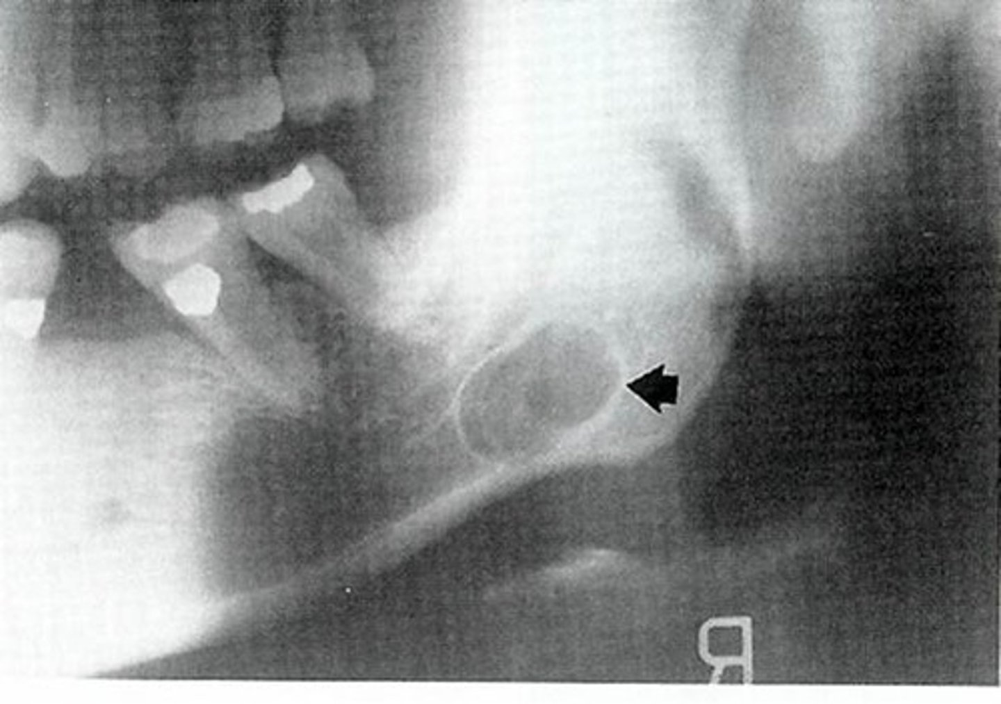 <p>well-defined cyst-like radiolucency</p>