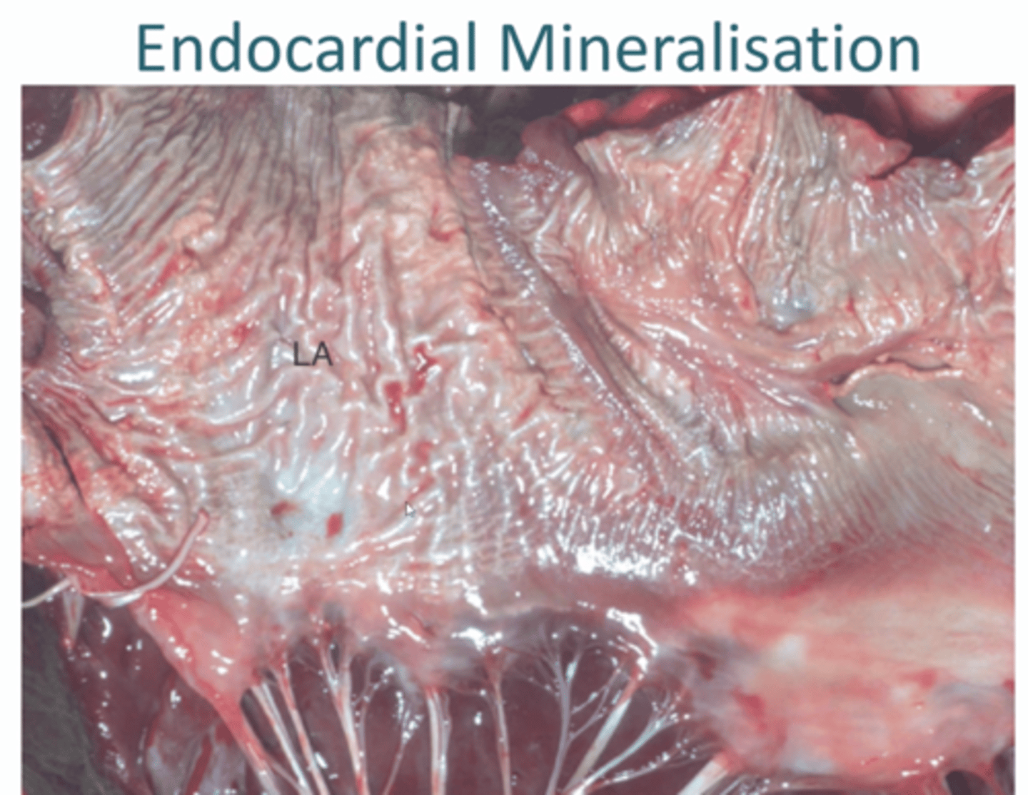 <p>Both can occur together or alone</p><p>1. Excess dietary vitamin D, firm white plaques of mineralised tissue in endocardium + intima large arteries</p><p>2. Chronically dilated hearts, cattle with Johne's disease, dogs with healed endocarditis lesions</p>
