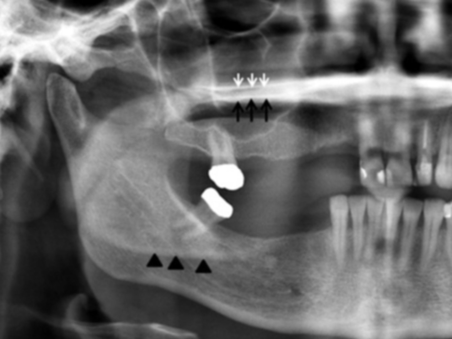<p>The white arrows represent the ___ hard palate</p><p>A) real</p><p>B) ghost</p>