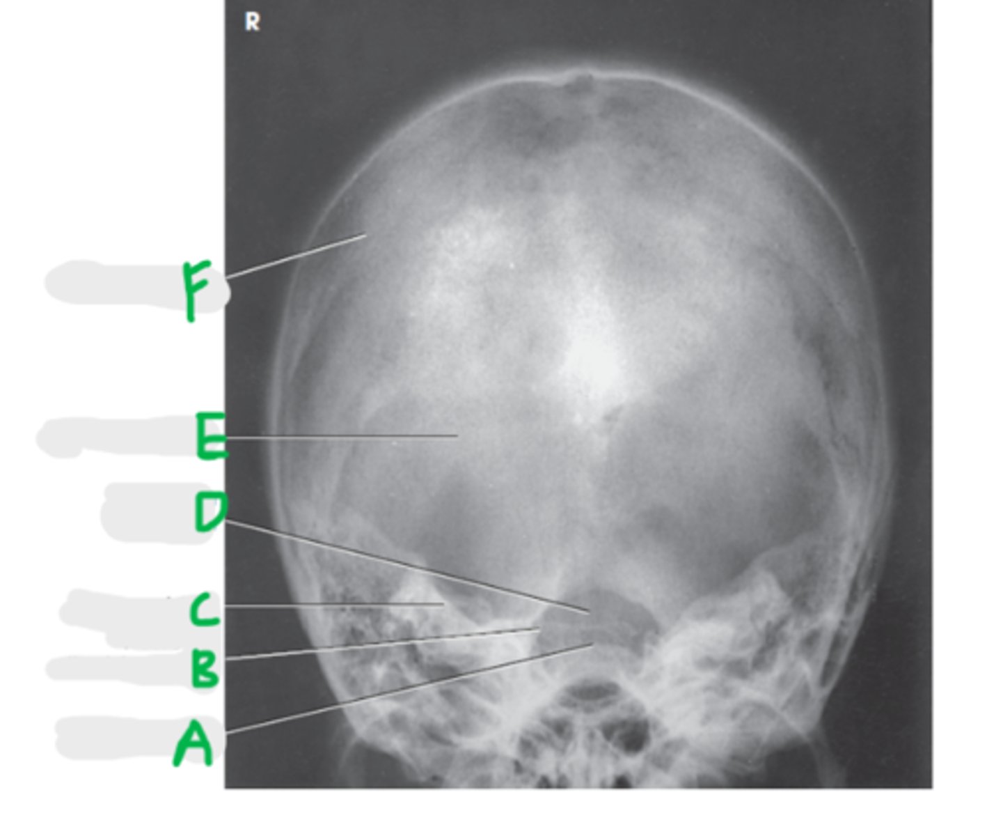 <p>How do we look for rotation on an AP axial (Townes) radiograph?</p>