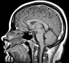 What is this plane view of the brain and why?