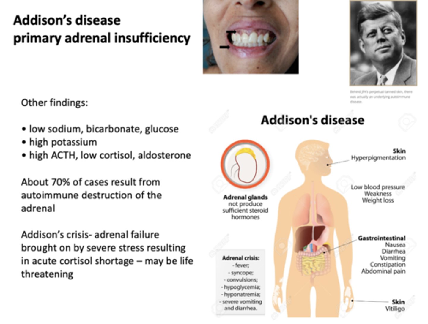 <p>autoimmune destruction of adrenal</p>