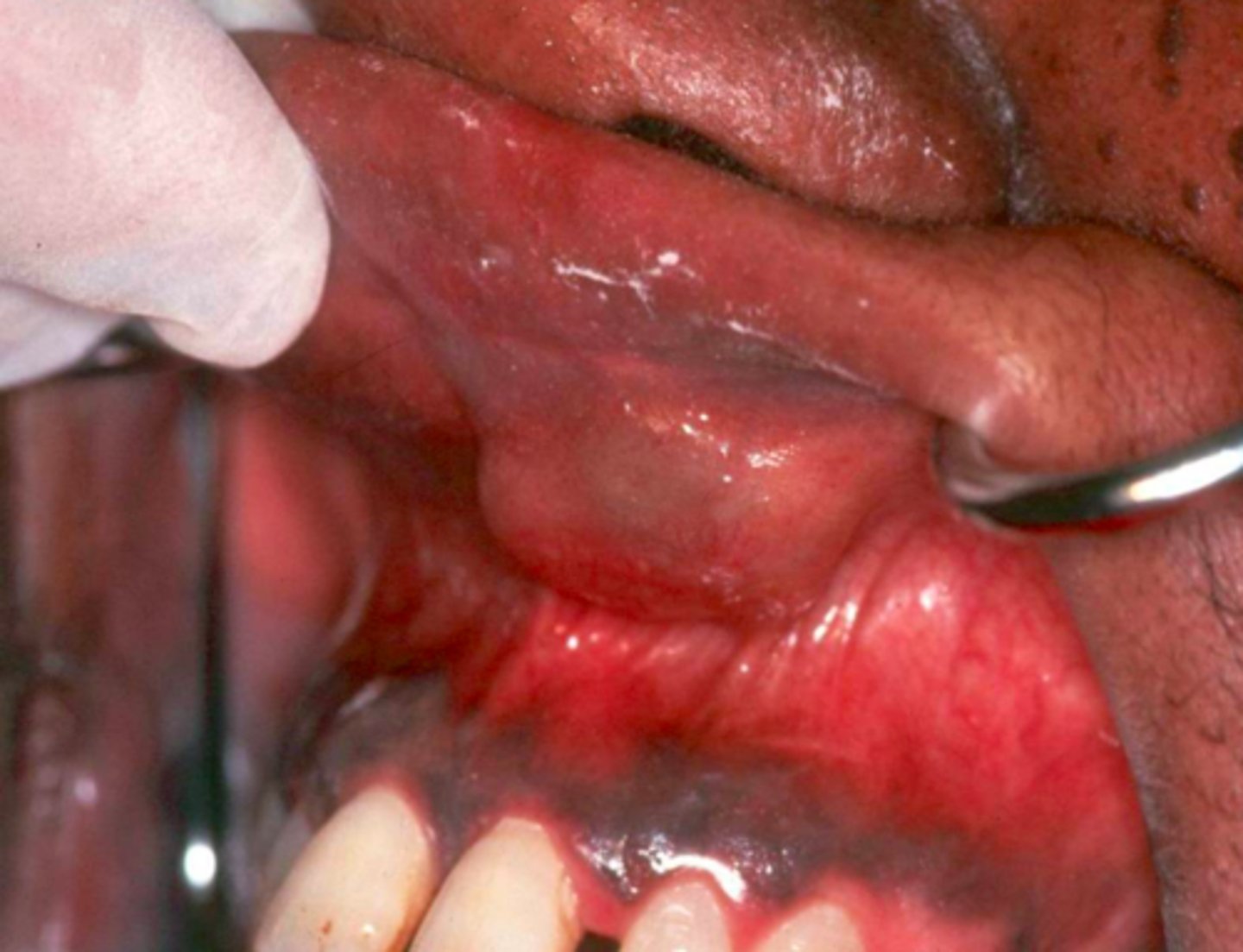 <p>What is the most common location for a Canalicular Adenoma to present (75%)?</p>