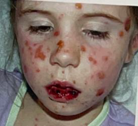 <ul><li><p>Identify the disease</p></li><li><p>Feature in the oral mucous membrane</p></li><li><p>Eye lesions feature</p></li><li><p>Genital lesions feature</p></li><li><p>Treatment</p></li><li><p>Prognosis</p></li></ul><p></p>