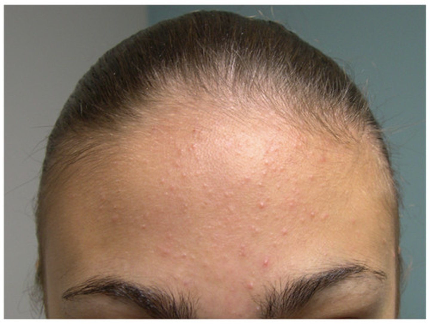 <p>minor breakouts, mostly open comedones, some closed comedones and a few papules</p>