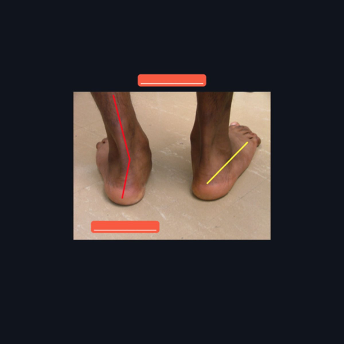 <p>Identify the foot condition with the red line and what hip condition is it under?</p>