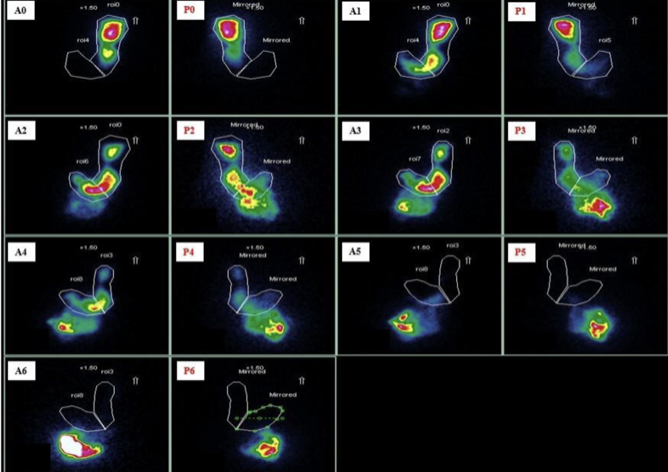 <p>Which imaging to assess for <strong>gastric emptying for gastroparesis? </strong></p><p><em>radioactive scrambled eggs </em><span data-name="radioactive" data-type="emoji">☢</span></p>