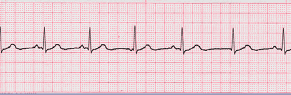<p>HR:60-100 bpm</p><p>P-wave: morphology</p><p>Regularity: Irregular</p><p>PR Interval: Normal</p><p>QRS Duration: Normal</p><p></p>