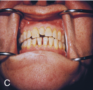 <ul><li><p>known as hyperdontia</p></li><li><p>extra teeth initiation from persisting clusters of the dental lamina </p></li><li><p>have a hereditary etiology</p></li><li><p>commonly between the maxillary central incisors, distal to the maxillary thid molar, and premolar region of both dental arches</p></li></ul><p></p>
