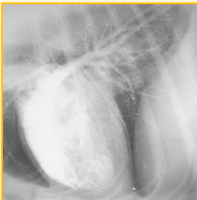 <p>Angiography - Contrast media used </p>