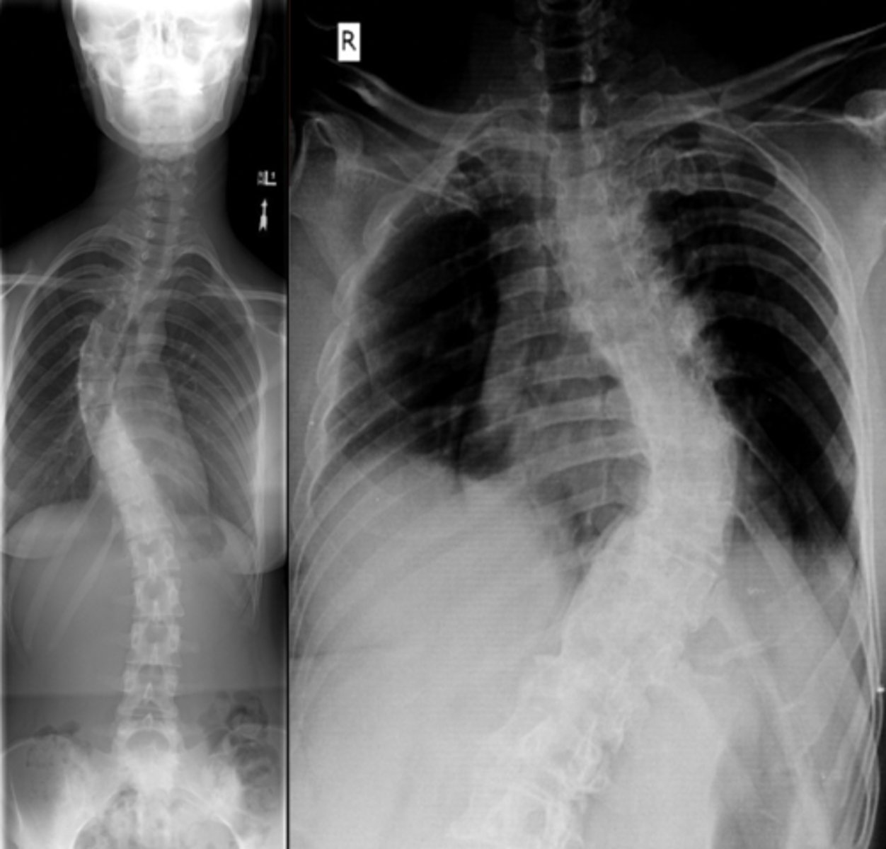 <p>abnormal lateral curvature of the spine</p>