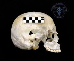 <p>Projectile Trauma</p>