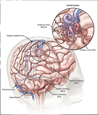 <p>congenital or fetal circulatory vascular malformation involving tangled dilated arteries or veins; blood bypasses brain tissue </p>