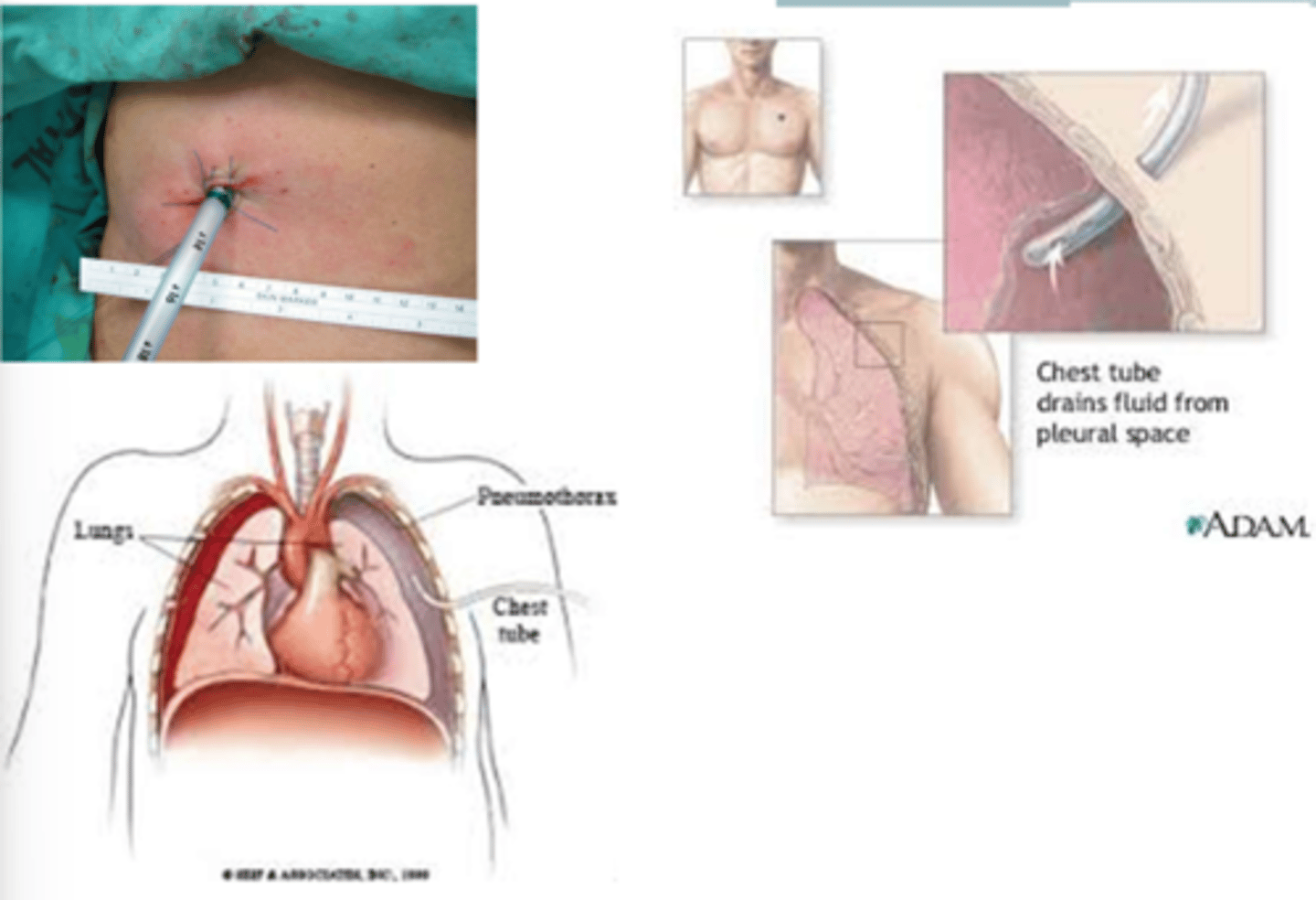 <p>Large catheter placed in the mediastinum, pericardium, or pleural space to drain fluid or air.</p>
