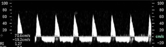 <p><span>This is a waveform from mid portion of MRA. What does this waveform indicate?&nbsp;</span></p>