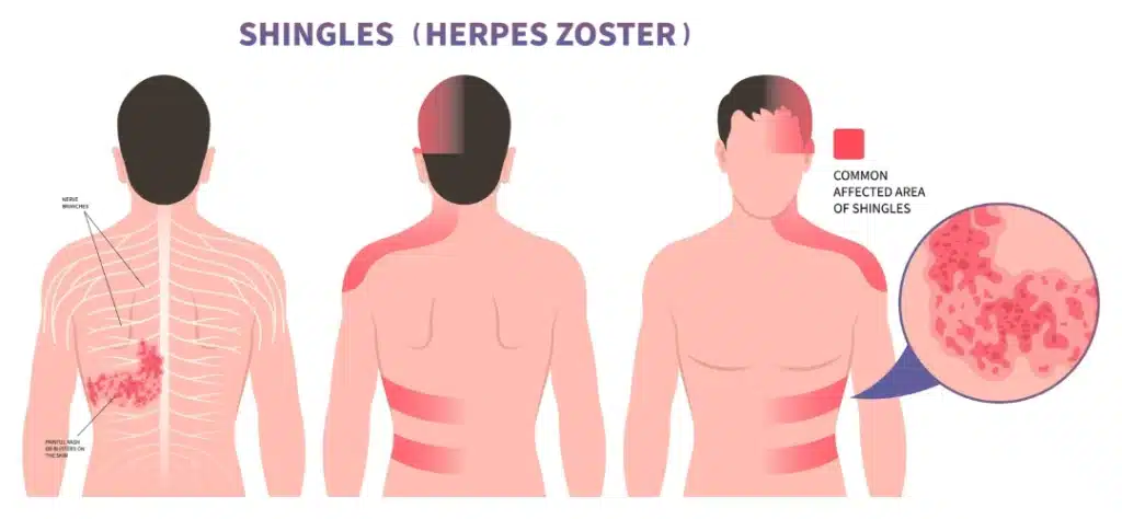 <ul><li><p><span><strong>Unilateral</strong>, local red, painful blister-like rash&nbsp;&nbsp;</span></p></li><li><p><span>Chronic severe pain post blister (postherpetic neuralgia)</span></p></li></ul><p></p>