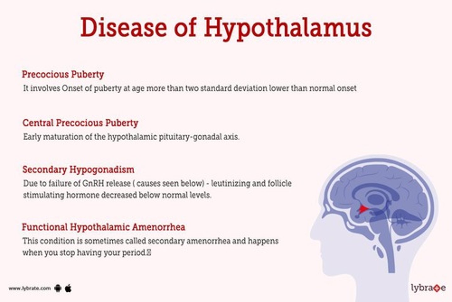 <p>A condition caused by increased ACTH production due to a tumor on the pituitary, leading to increased cortisol production.</p>