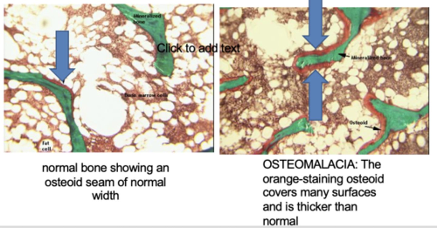 <p>more osteoid (orange) around the bone (green) which has accumulated bc it is not properly mineralized</p>