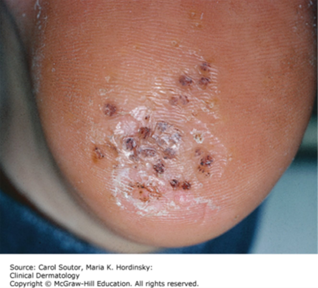<p>A contagious infection of the epidermal layer of the skin</p>