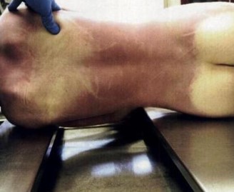 <p>Dark “bruise-like” discoloration due to blood settling into dependent parts of the body</p><p>Can help determine TOD and can indicate whether a body was moved</p><p>A corpse facing upwards will have lividity on back; one laying on left side will have lividity along left side of body</p>