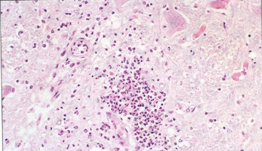 <ol><li><p>Listeriosis</p></li><li><p>Sheep</p></li><li><p>Medulla (Microabscess)</p></li><li><p>Hematoxylin-Eosin</p></li></ol><p></p>