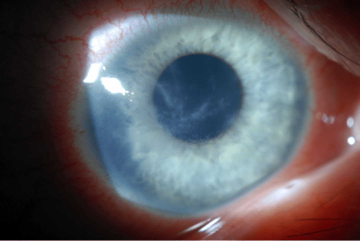 <p>keratitis caused by Acanthamoeba keratitis</p>