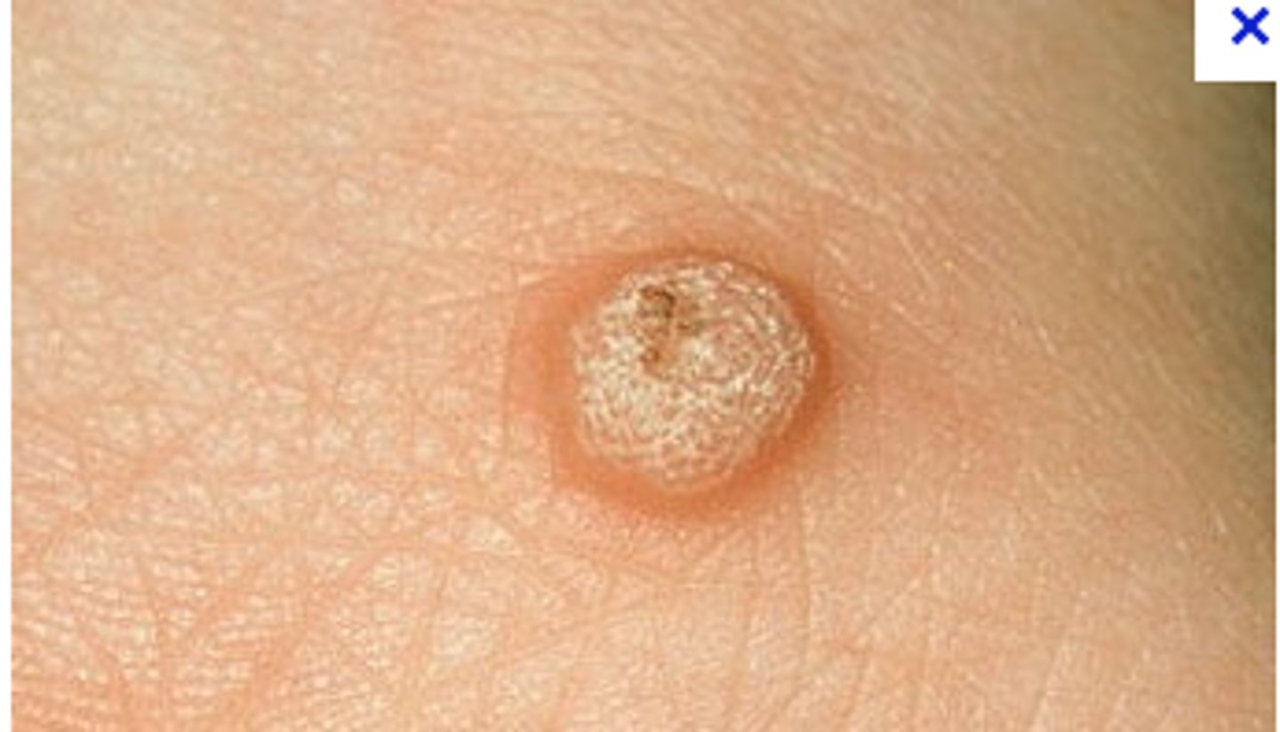 <p>HPV</p><p>tx: cryotherapy (liquid nitrogen), electrocautery, OTC salicylic acid, CO2, laser, intralesional bleomycin, intralesional candida albicans to trigger immune response to area</p>