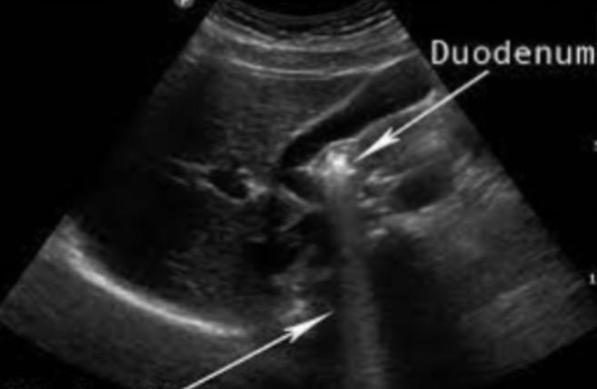 <ul><li><p><span style="background-color: transparent;">Also behind a strongly attenuating structure, but the structure produces some echoes but is highly attenuated in the process</span></p></li><li><p><span style="background-color: transparent;">Appears as a hypoechoic shadow behind a structure</span></p></li><li><p><span style="background-color: transparent;">Commonly seen with bowel</span></p></li><li><p><span style="background-color: transparent;">Can be reduced by spatial compounding</span></p></li></ul><p></p>