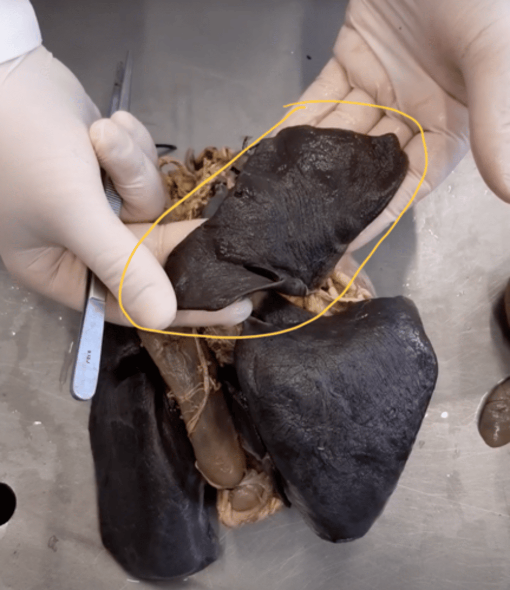 <p>What lobe?</p>